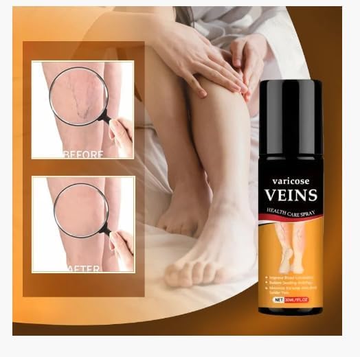 Varicose Veins
