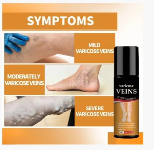 Varicose Veins